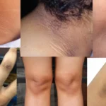 Dark velvety patches on the neck seen in acanthosis nigricans linked to diabetes