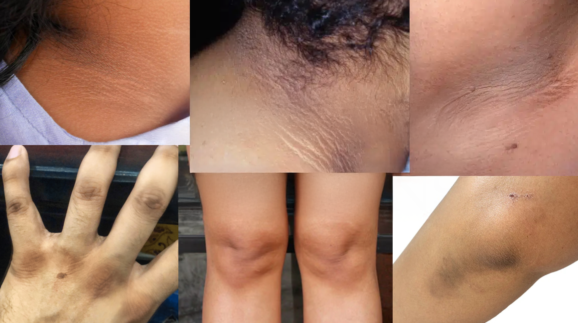 Dark Patches on the Neck? Acanthosis Nigricans and Diabetes Warning Signs